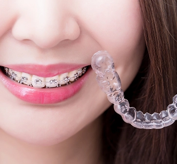 Invisalign® clear aligners (removable aligner system)