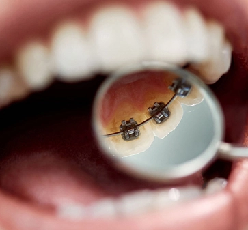 Lingual braces (braces placed behind the teeth)