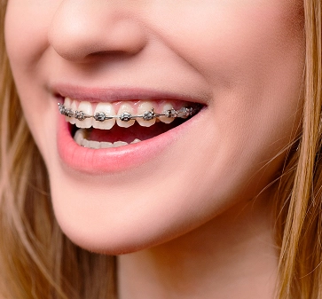 Metal braces (traditional fixed braces)