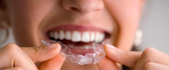 Cost of Clear Aligners