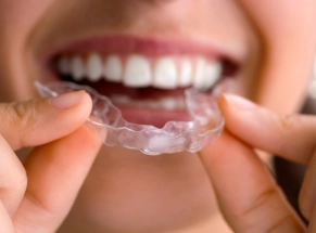 Clear Aligners