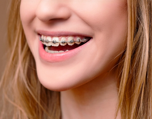 Braces