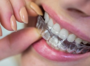 Invisalign®