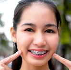 Braces Color Ideas for Spring