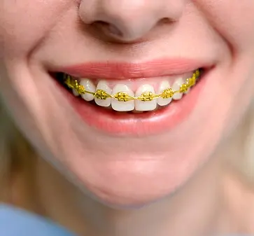 Gold Braces (Gold-Colored Fixed Braces)