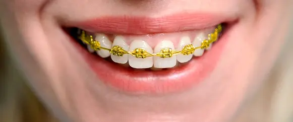 Cost of Gold Braces