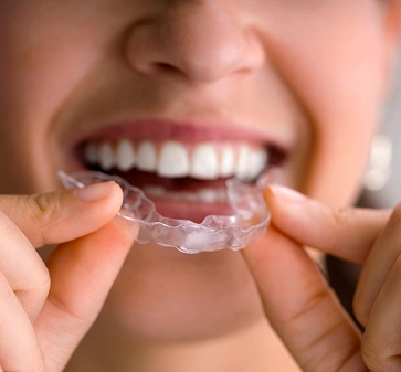 Invisalign® clear aligners (removable aligner system)