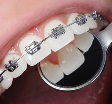 Self-ligating braces (brackets with built-in clips)