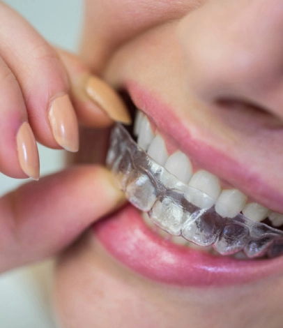 How Long Do Retainers Last