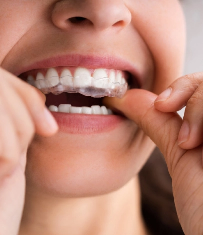 How to Clean a Retainer