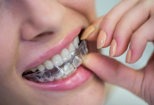 When Clear Aligners May Be Appropriate for Teens