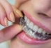 Clear Retainers Icon