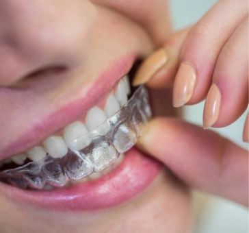 Clear retainers