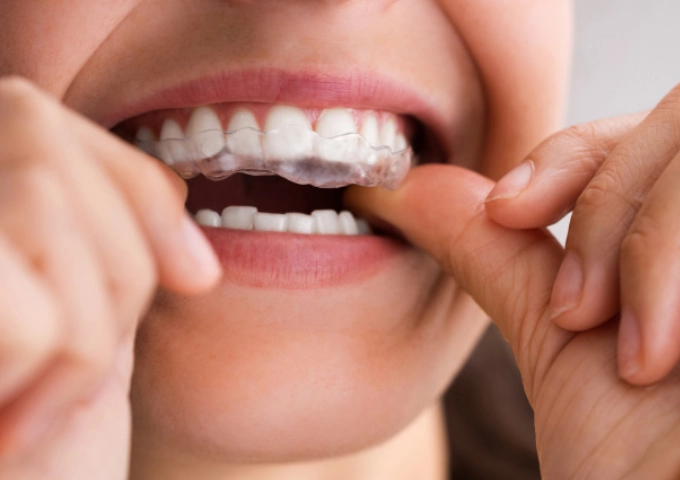 Orthodontic Retainers