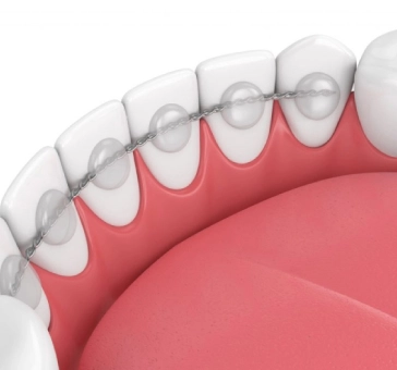 Permanent retainers