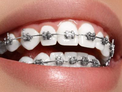 traditional metal braces woodstock